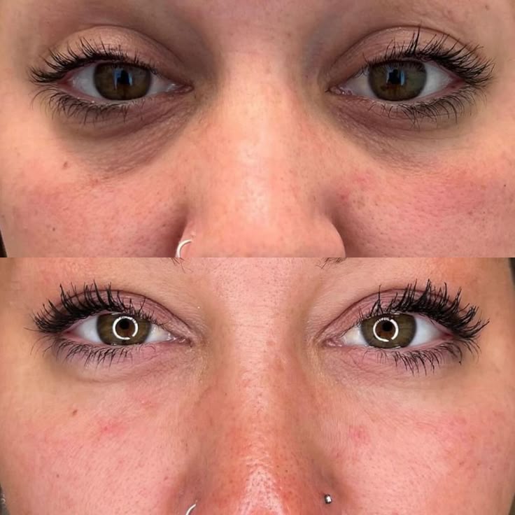 PRP Under-Eye Rejuvenation PRICE: $600