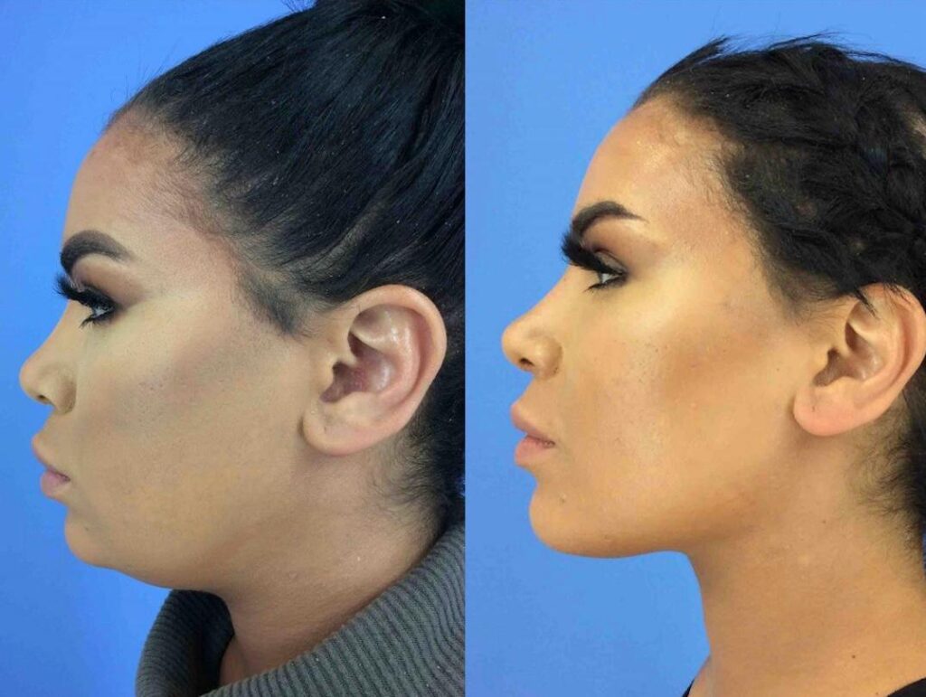 Kybella ® $595 +