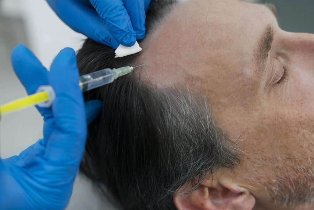 PRP Hair Restoration